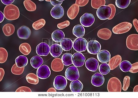 Acute Lymphoblastic Leukemia, Bone Marrow Smear, 3d Illustration