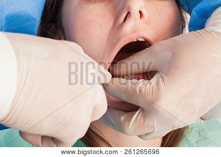 Surgeon Removing The Wisdom Tooth With His Assistant