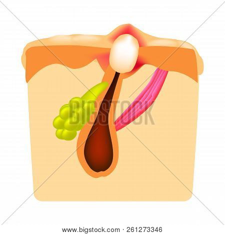 Closed Comedones. White Heads Acne. The Structure Of The Skin. Infographics. Vector Illustration On 