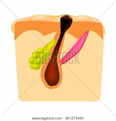 Open Comedones. Black Head Acne. The Structure Of The Skin. Infographics. Vector Illustration On Iso