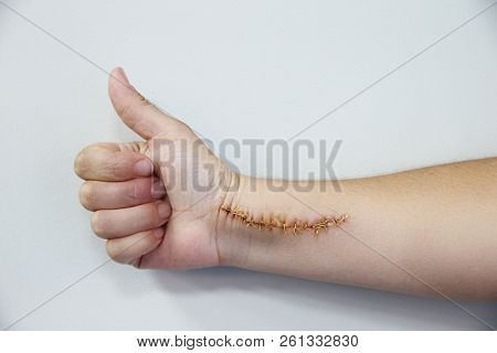 Humand Hand Hurt With A Big Scar With A Lot Of Stitches. Horizontal Shot