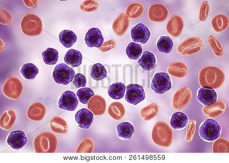 Acute Lymphoblastic Leukemia, Bone Marrow Smear, 3d Illustration