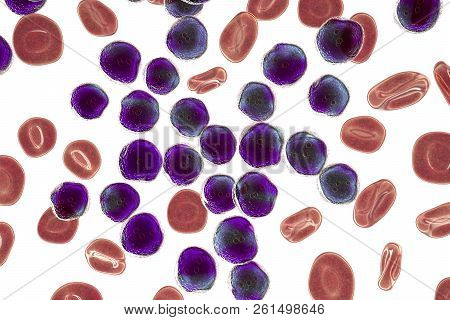 Acute Lymphoblastic Leukemia, Bone Marrow Smear, 3d Illustration