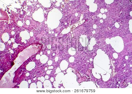 Lobar Pneumonia, Hemorrhagic Edema Period, Light Micrograph, Photo Under Microscope