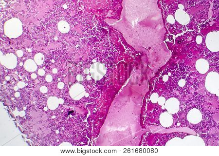 Lobar Pneumonia, Hemorrhagic Edema Period, Light Micrograph, Photo Under Microscope