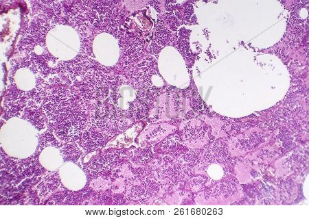 Lobar Pneumonia, Hemorrhagic Edema Period, Light Micrograph, Photo Under Microscope