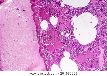 Lobar Pneumonia, Hemorrhagic Edema Period, Light Micrograph, Photo Under Microscope