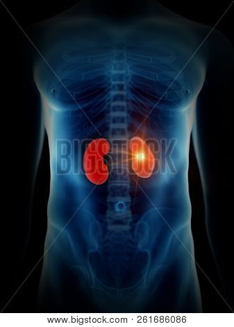 3d rendered medically accurate illustration of a painful kidney