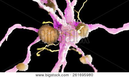 3d rendered medically accurate illustration of amyloid plaques on a alzheimer nerve cell