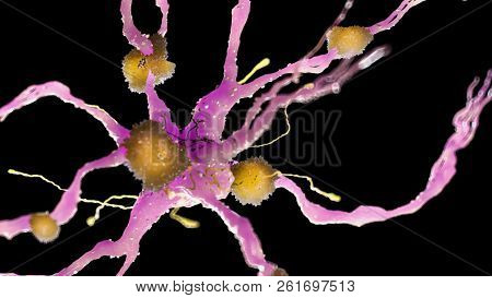 3d rendered medically accurate illustration of amyloid plaques on a alzheimer nerve cell