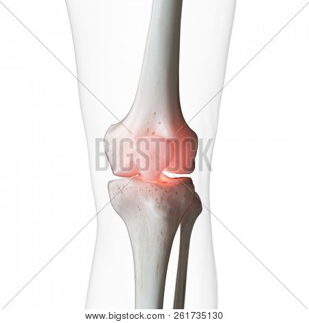 3d rendered medically accurate illustration of a painful knee