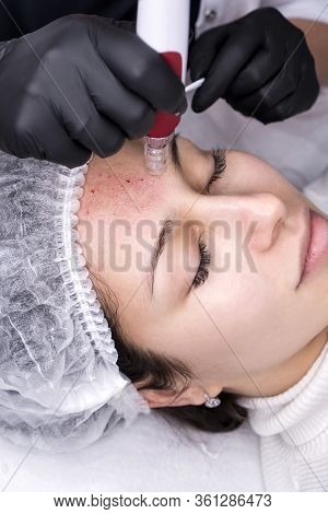 Cosmetologist Making Mesotherapy Injection. Microneedle Mesotherapy. Treatment Woman At Beautician. 