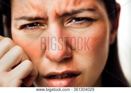 Woman With Painful Hot Sunburn,facial Skin Redness Problem,photosensitivity.chemical Burn,allergic R