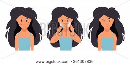 Acne Treatment. Unhappy Girl Struggling With Acne, Pimples.