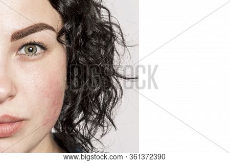 Half Face Of A Young Beautiful Girl With Redness On The Skin. Seasonal Allergy Close-up. Space For T