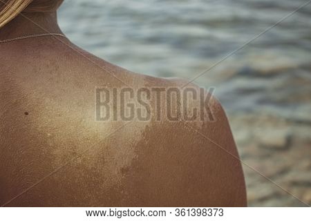 The Girl's Sunburned Shoulder. Peels And Flakes The Skin On The Back And Shoulder From The Sun
