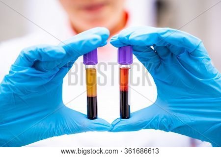 Laboratory Assistant With Blood Samples In Hands. Assistance In Gloves. Prevention. Pneumonia Diagno