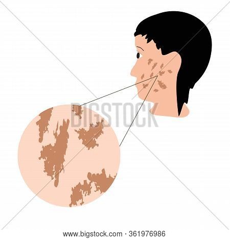Pigmentation On The Skin. A Pigmented Spot On The Skin Of The Face. Vector Illustration