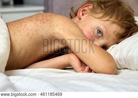 Sad Look Of A Sick Child Covered In A Red Rash And Lying On A Bed Under A Blanket. A Little Boy Is M