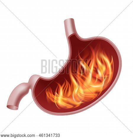 Burning Stomach. Realistic Human Organ Of Internal Digestion System On Fire.