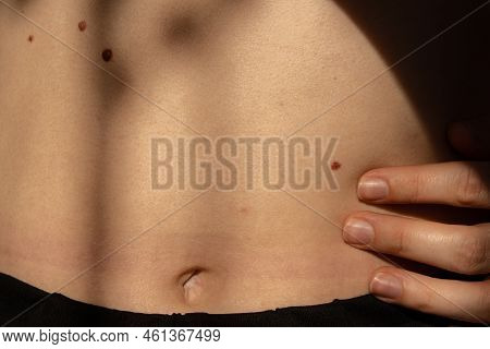 Birthmarks On Skin Close Up Detail Of The Bare Skin Sun Exposure Effect On Skin, Health Effects Of U