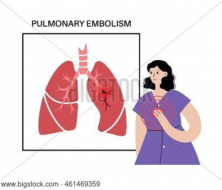 Pulmonary Embolism Disease. Deep Vein Thrombosis In Female Cartoon Body. Blood Clot In Lung Vein Ana