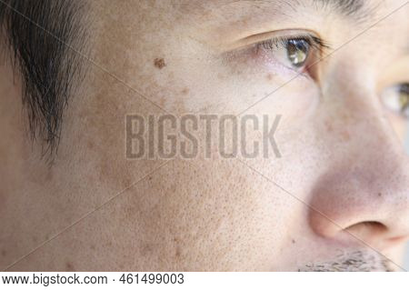 Close Up Asian Man Face With Freckles Dark Spots From Uv Light , Skin Care And Health Problem Concep