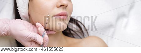 Face Lifting Pdo Suture Operation. Innovative Technique Of New Thread Lift, Cosmetologist Preparing 