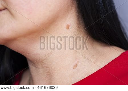 Birthmarks On Skin Close Up Detail Of The Bare Skin Sun Exposure Effect On Skin, Health Effects Of U