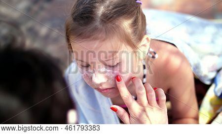 Close-up, The Child, Girls, Severe Sunburn On The Face. Mom Smears Places Of Burns Abundantly With A