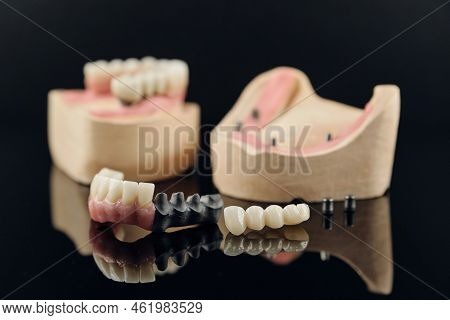 Composition Of Dental Crowns And Orthopedic Components On A Black Background. Zirconia Full Anatomy
