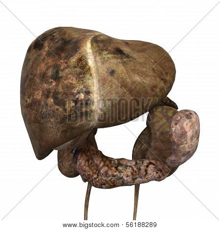 Sick Human Liver