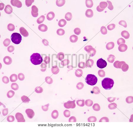 Acute Lymphoblastic Leukemia(all)