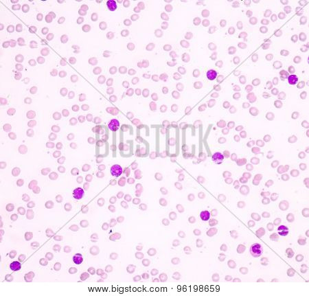 Acute Lymphoblastic Leukemia(all)