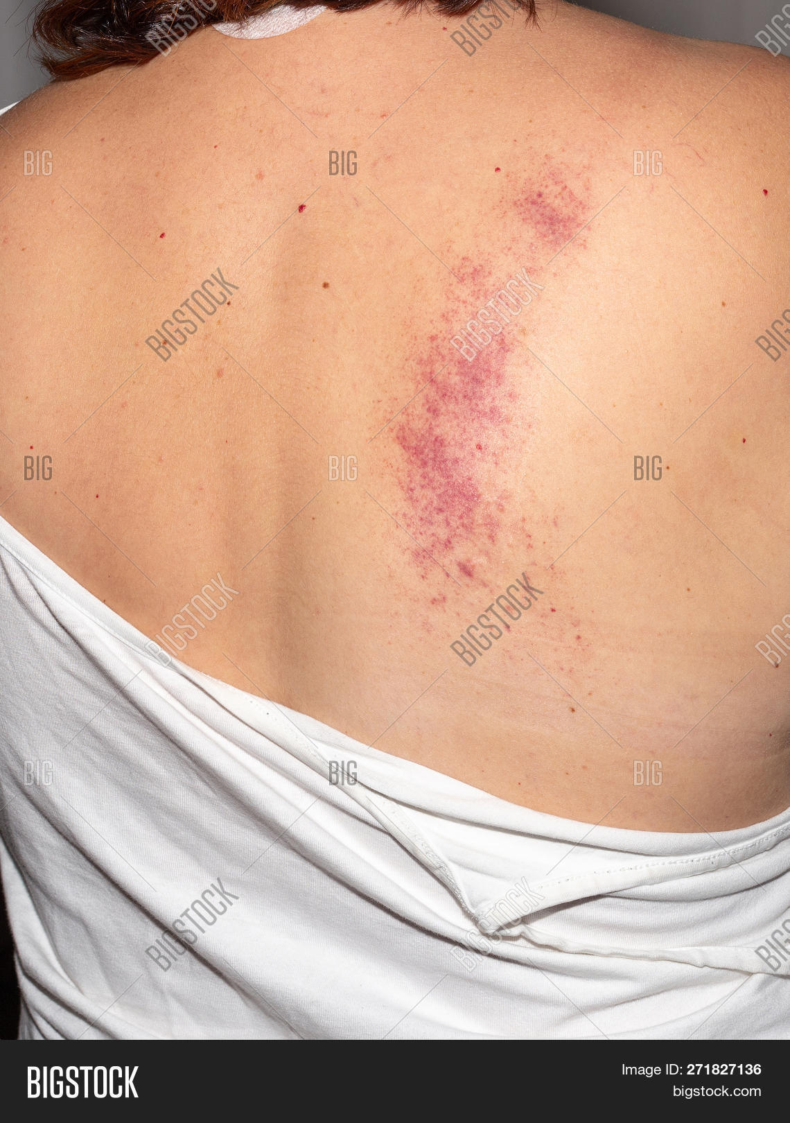 Bruise. Pain. Woman. Image & Photo (Free Trial) Bigstock
