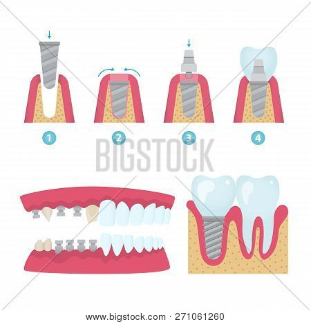 Set Of Dental Crowns And Implantation Prosthodontics Elements And Tools. Vector Flat Illustration.