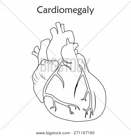 Cardiomegaly. Enlarged Heart Muscle. Anatomy Flat Illustration. Outline Image, White Background.