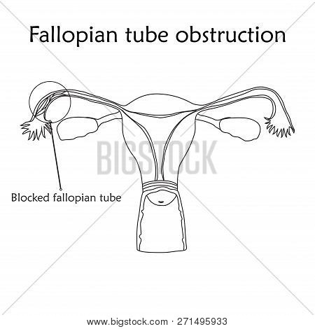 Fallopian Tube Vector & Photo (Free Trial) | Bigstock