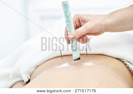 Woman Being Treated With Acupuncture And Moxibustion Treatments