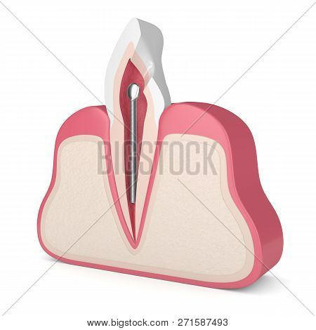 3d Render Of Tooth With Dental Stainless Steel Post In Gums. Endodontic Treatment Concept