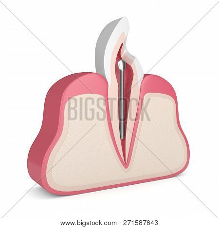 3d Render Of Tooth With Dental Stainless Steel Post In Gums. Endodontic Treatment Concept