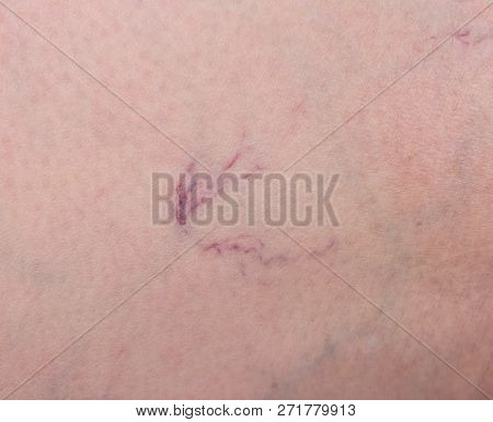 Footprint On The Skin From Vascular Dilatation Of Veins, Vascular Pattern On Human Skin, Close-up, P