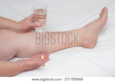 A Woman Is Holding A Pill For Treating Varicose Veins On Her Legs And A Glass Of Water, Drugs For Th