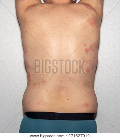 Allergy. Reaction. Health. Histamine. Intolerance