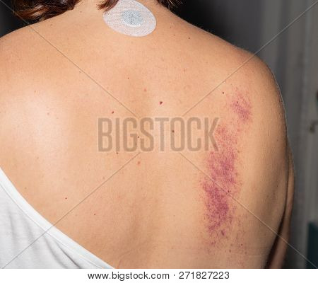 Bruise. Woman. Back. Pain. Medical. Treatment