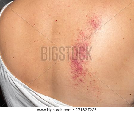 Bruise. Woman. Pain. Back. Medical. Treatment