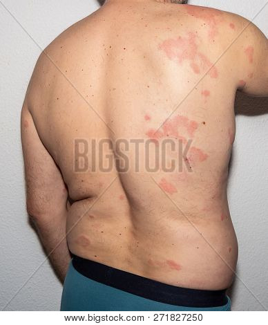 Health. Allergy. Reaction. Histamine. Intolerance