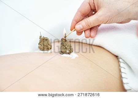 Woman Being Treated With Acupuncture And Moxibustion Treatments