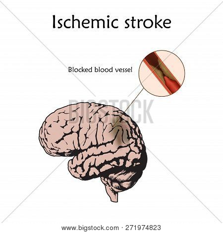 Ischemic Stoke Poster, Banner. Vector Medical Illustration. White Background, Anatomy Flat Image Of 