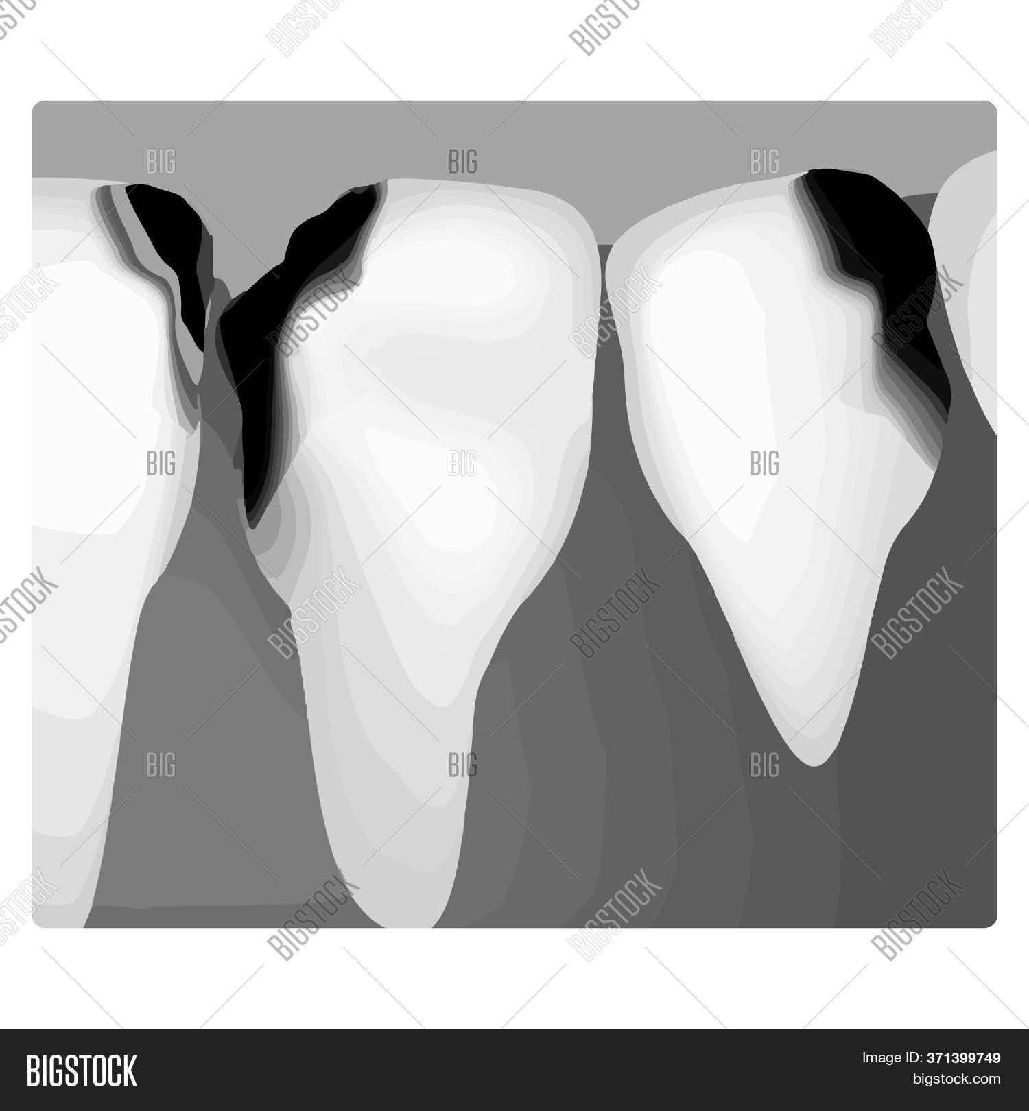 Dental Caries. Xray Image & Photo (Free Trial) Bigstock